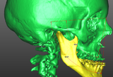 III classe scheletrica - cefalometria 3D attuale